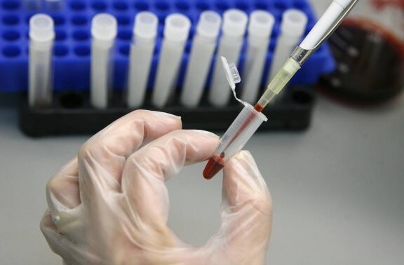 Cientistas relatam segundo caso de cura do HIV