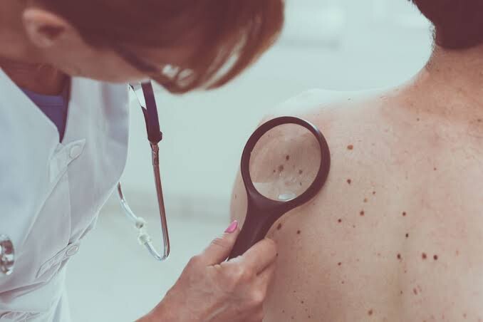 Campanha contra câncer de pele é estendida até o fim do verão